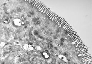celiakia celiakia